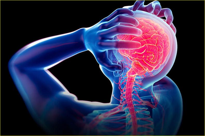 МИГРЕНЬ: Как себе помочь БЕЗ ЛЕКАРСТВ